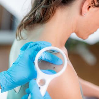 ​Hoe wordt een melanoom verwijderd?